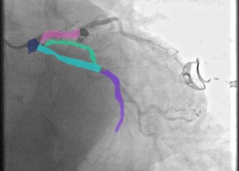 Doctorando de la UAS desarrolla método experimental a partir de imágenes de angiogramas para prevenir enfermedades cardiacas graves
