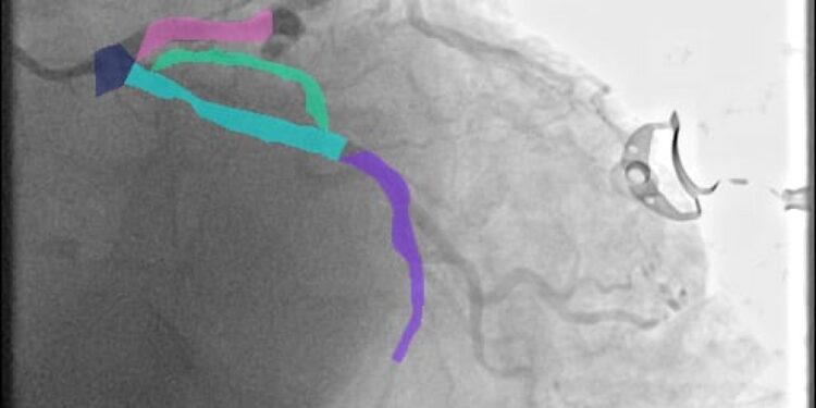 Doctorando de la UAS desarrolla método experimental a partir de imágenes de angiogramas para prevenir enfermedades cardiacas graves