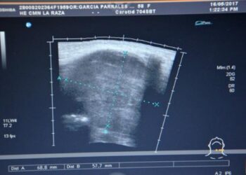 Un tratamiento adecuado y un estilo de vida saludable son clave de manera efectiva el hipotiroidismo, explica endocrinóloga del CIDOCS