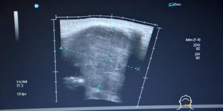 Un tratamiento adecuado y un estilo de vida saludable son clave de manera efectiva el hipotiroidismo, explica endocrinóloga del CIDOCS