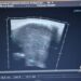 Un tratamiento adecuado y un estilo de vida saludable son clave de manera efectiva el hipotiroidismo, explica endocrinóloga del CIDOCS