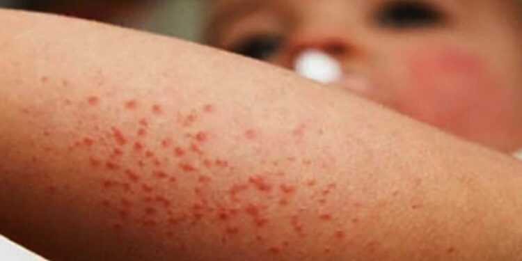 Ante el brote de sarampión que hay en el país, especialista de la UAS pide a la población sinaloense acudir de inmediato al médico si presenta síntomas